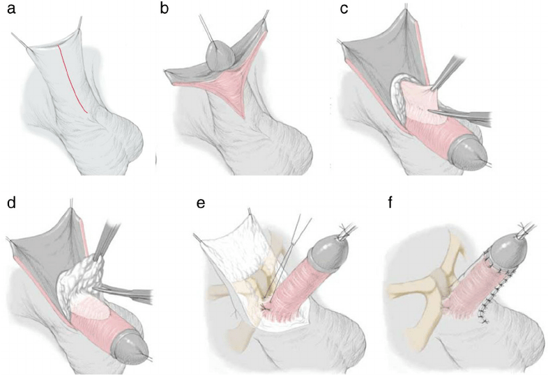 ligamentotomy para sa pagpapalaki ng ari