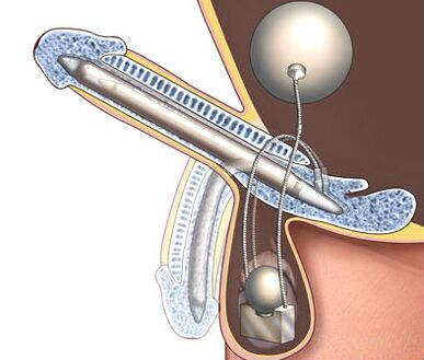 prosthesis ng ari para palakihin ito